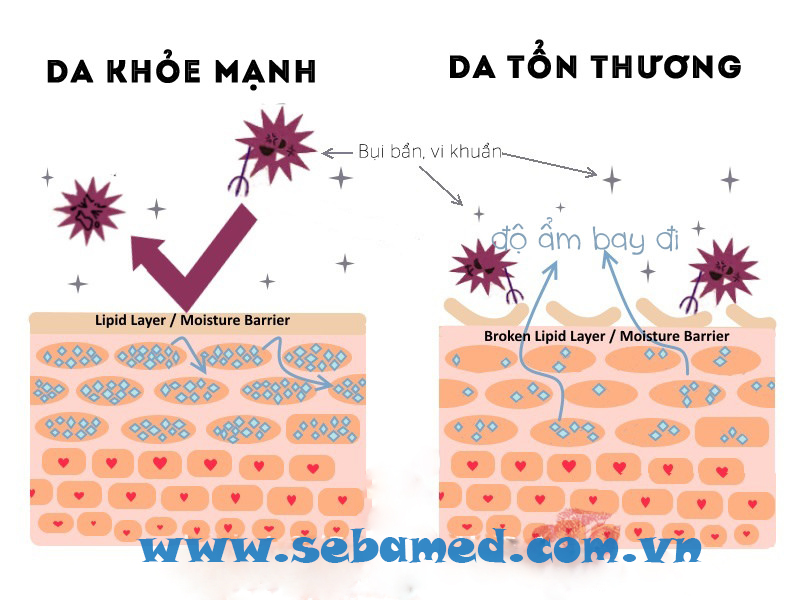 Chăm sóc da mụn hiệu quả – www.sebamed.com.vn