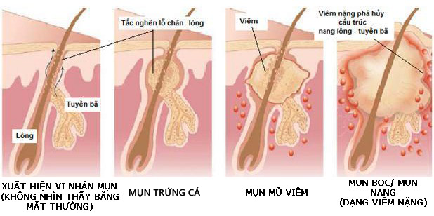 Giải quyết nỗi lo mụn tuổi dậy thì – www.sebamed.com.vn