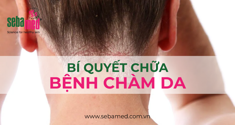 chàm da