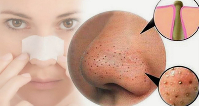 Mẹo trị mụn và se khít lỗ chân lông hay nhất – www.sebamed.com.vn