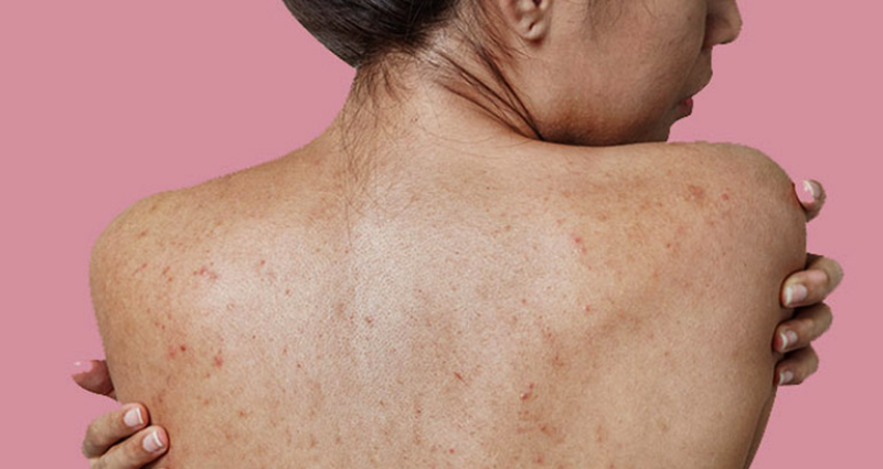 Cách trị dứt điểm mụn lưng an toàn và hiệu quả - sebamed Trị dứt điểm mụn lưng chuyện dễ hay khó