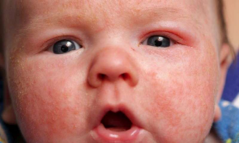 Viem da o tre so sinh benh Eczema - 2