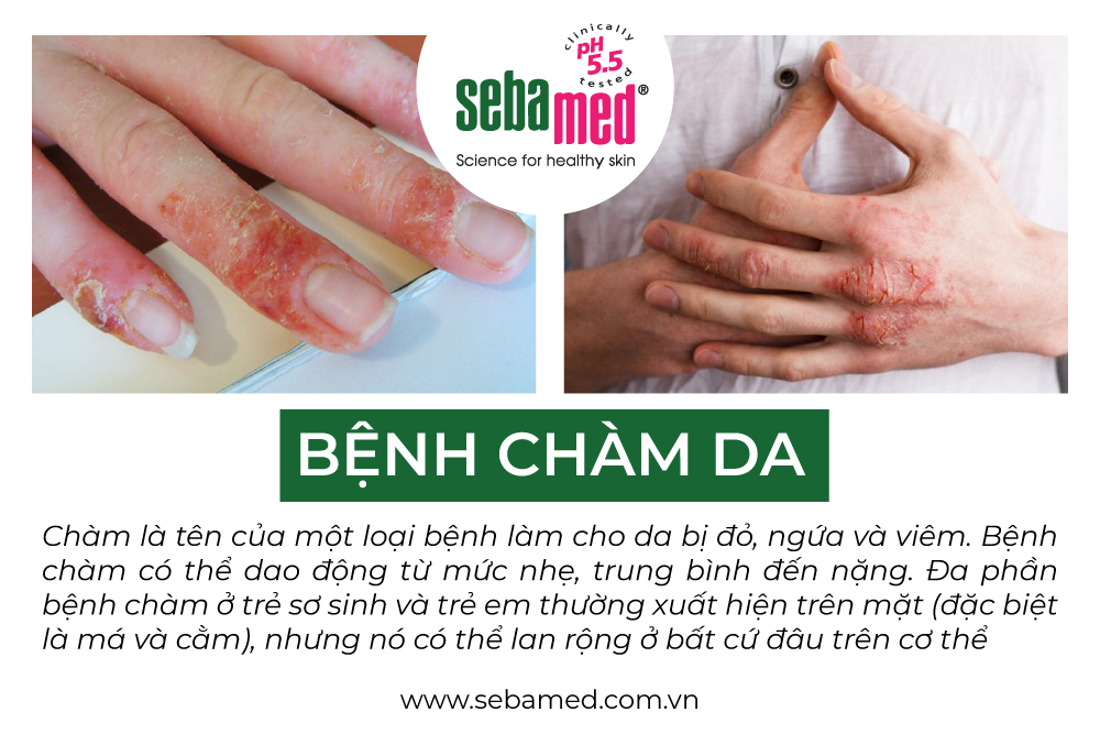 Bệnh chàm là gì?
