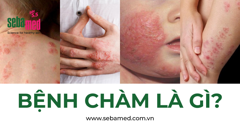 Bệnh chàm