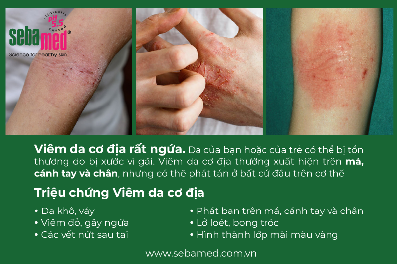 Viêm da cơ địa