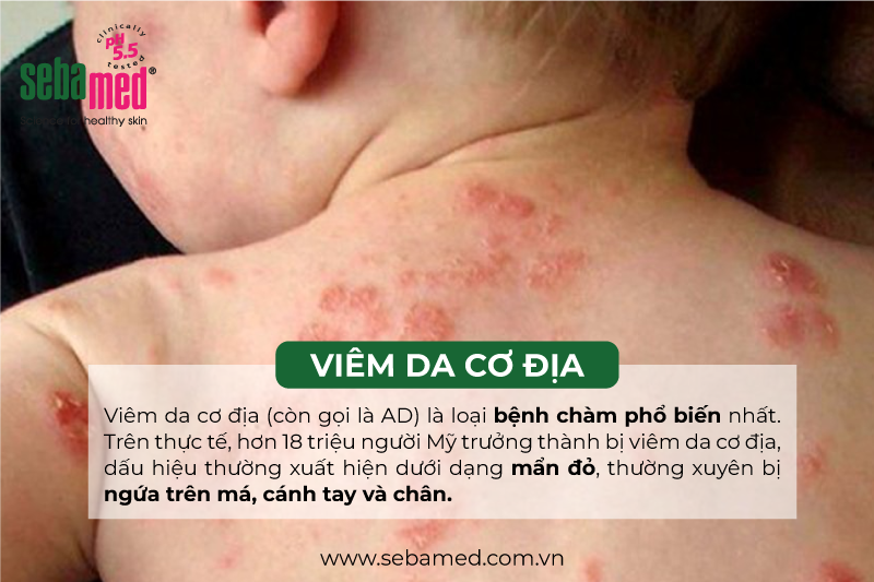 viêm da cơ địa