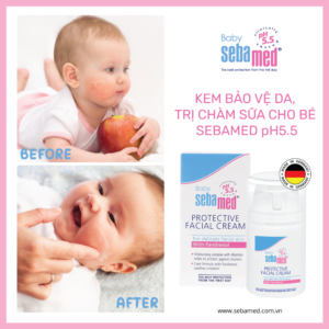 Viêm da cơ địa, chàm sữa, viêm da tiếp xúc - 2 - sebamed Kem Dưỡng Ẩm Chàm Sữa Cho Bé Sebamed pH5.5 (50ml)