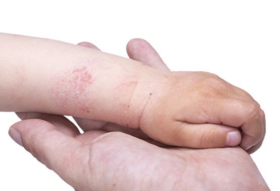 benh cham eczema 1 - 2