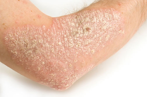 bieu chung cua eczema - 2