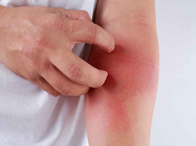 eczema o nguoi lon - 5