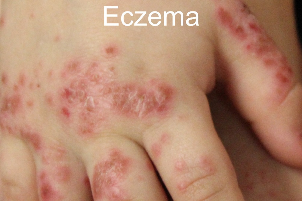 eczema tre duoi 2 tuoi - 3
