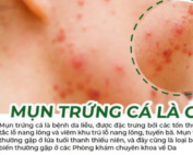 Mụn trứng cá là gì – www.sebamed.com.vn
