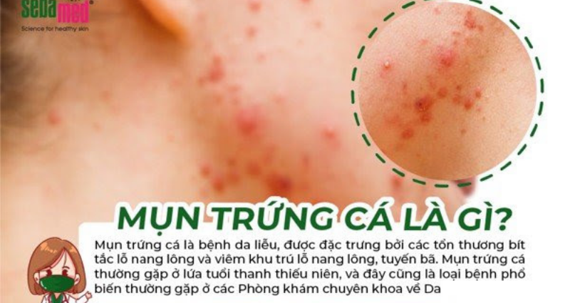 Mụn trứng cá là gì – www.sebamed.com.vn