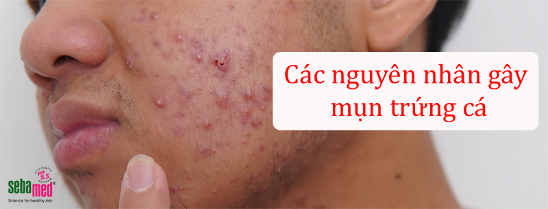 Mụn trứng cá là gì? Tìm hiểu các nguyên nhân mọc mụn trứng cá.
