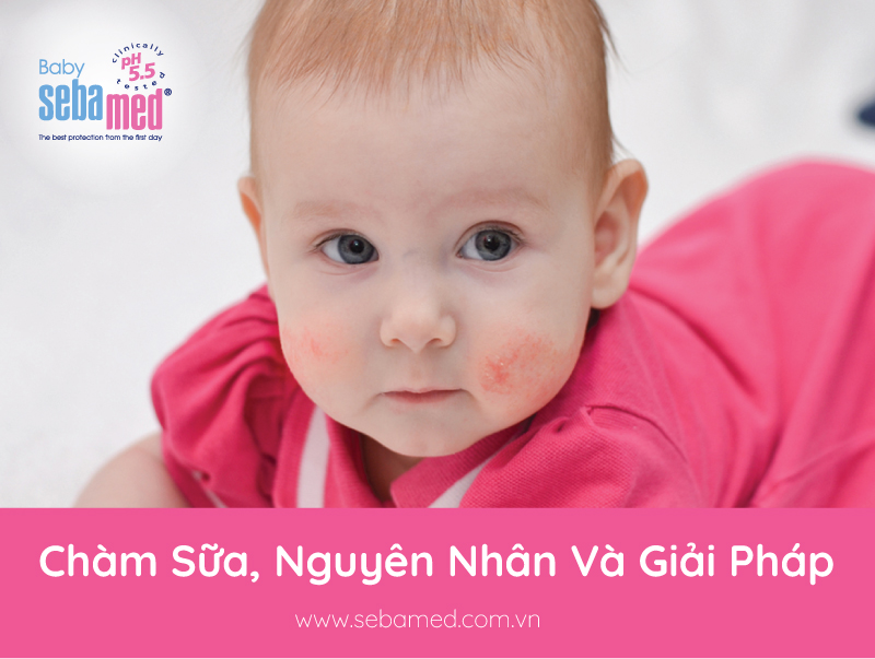 Chàm Sữa, Nguyên Nhân Và Giải Pháp