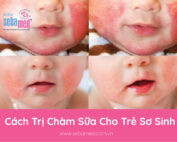 Cách Trị Chàm Sữa Cho Trẻ Sơ Sinh