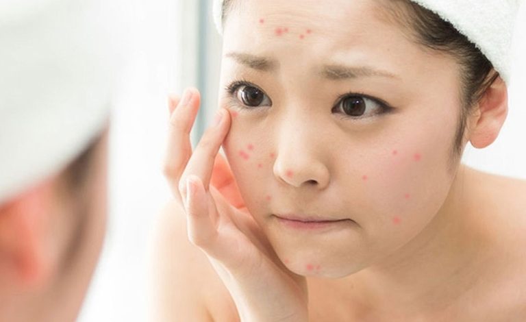 Panthenol là gì? Có những công dụng gì? - 3 - sebamed Cách-trị-mụn-tại-nhà-nhanh-nhất