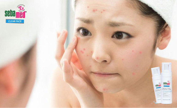 Cách trị mụn tại nhà hiệu quả nhanh nhất sau 1 đêm - sebamed Cách trị mụn hiệu quả nhanh nhất sau 1 đêm – www.sebamed.com.vn