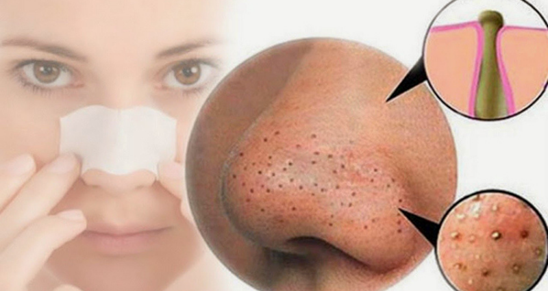 Cách trị mụn đầu đen tại nhà – www.sebamed.com.vn