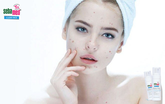 cách trị mụn thâm hiệu quả nhất