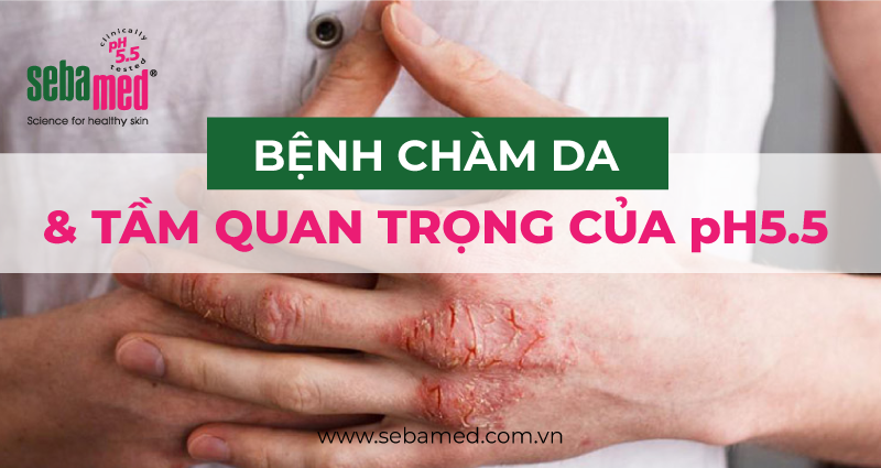 bệnh chàm da