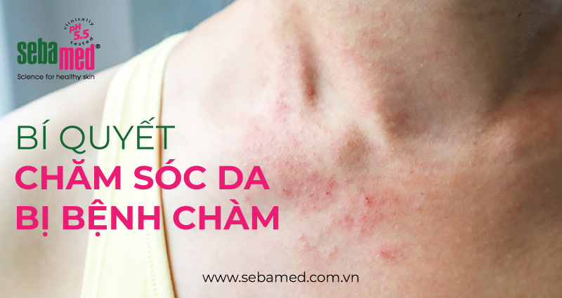 bệnh chàm da