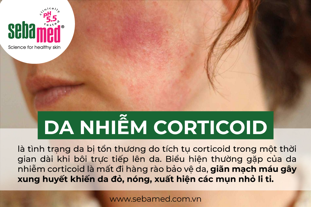 Da nhiễm Corticoid