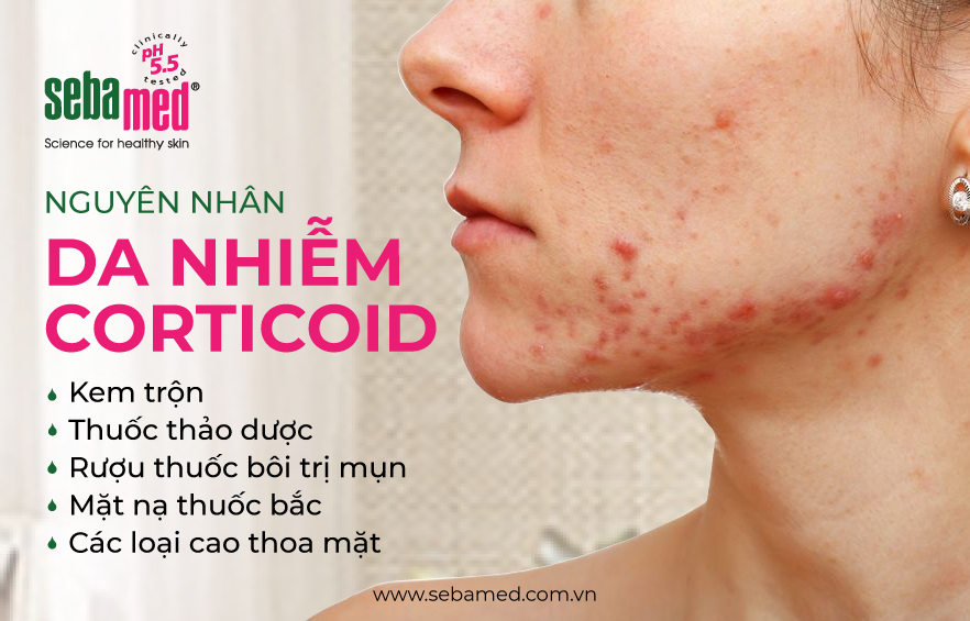 Da nhiễm corticoid 