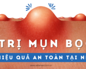 Cách trị mụn bọc hiệu quả an toàn tại nhà