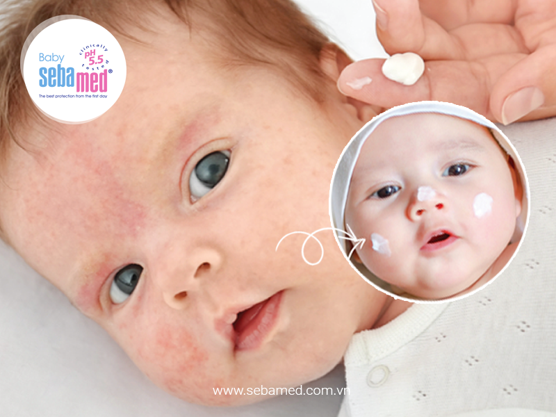Kiểm soát bệnh Chàm da bằng cách dưỡng ẩm