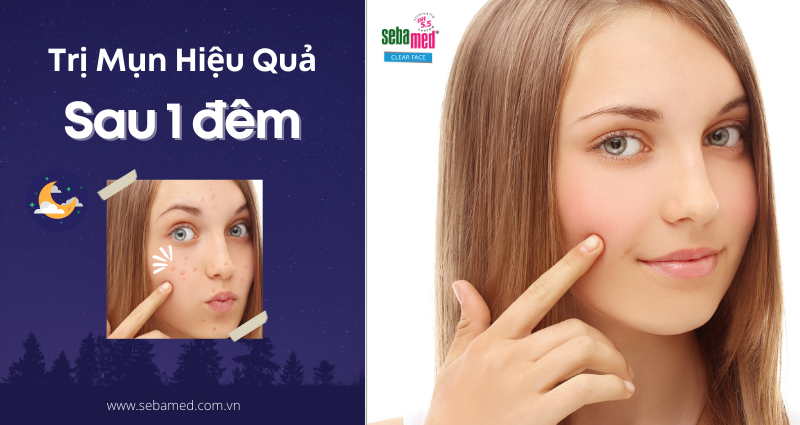 Cách trị thâm mụn hiệu quả sau một đêm – www.sebamed.com.vn