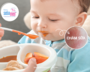 Mối Liên Quan Giữa Ăn Uống Và Chàm Sữa
