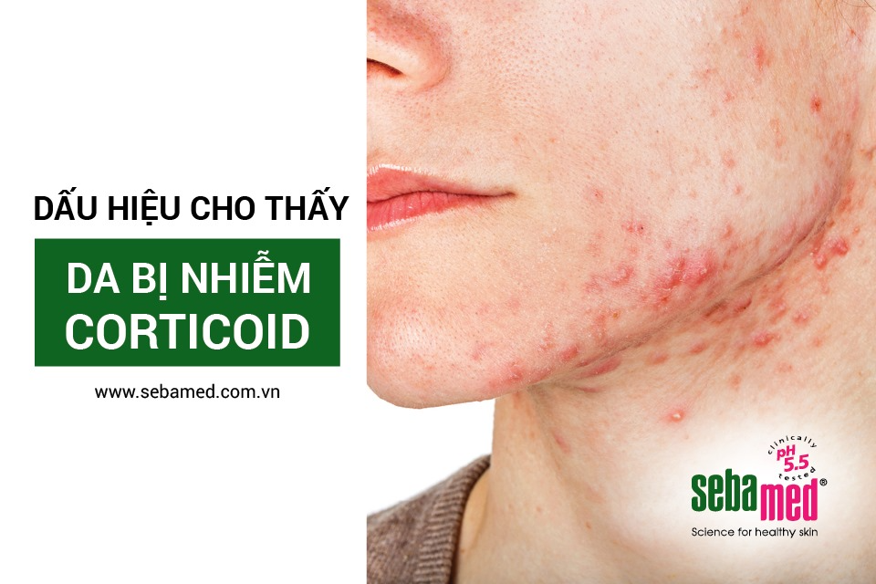 dau hieu da bi nhiem corticoid - 1