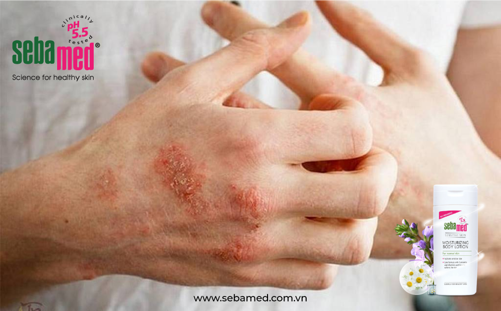 Cách giảm ngứa bệnh chàm da chuẩn khoa học - 1 - sebamed Ngứa do bệnh chàm da