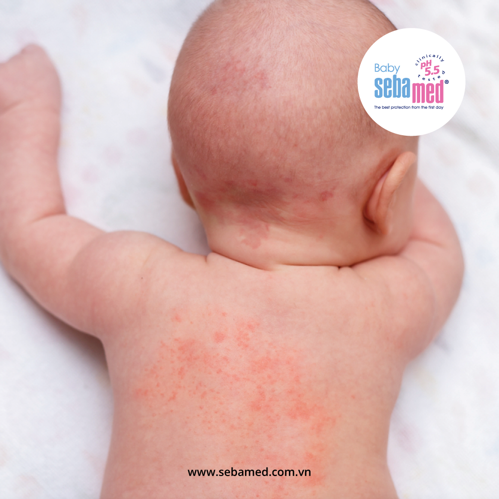 Các bệnh về da ở trẻ sơ sinh thường gặp - 1 - sebamed 312 - 2
